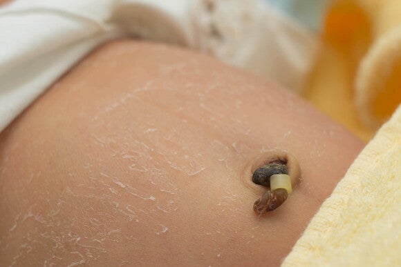 cordon umbilical cordon umbilical